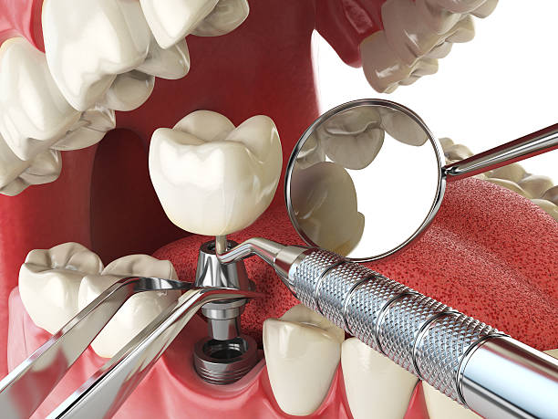 Best Emergency Wisdom Teeth Removal in Stone Park, IL